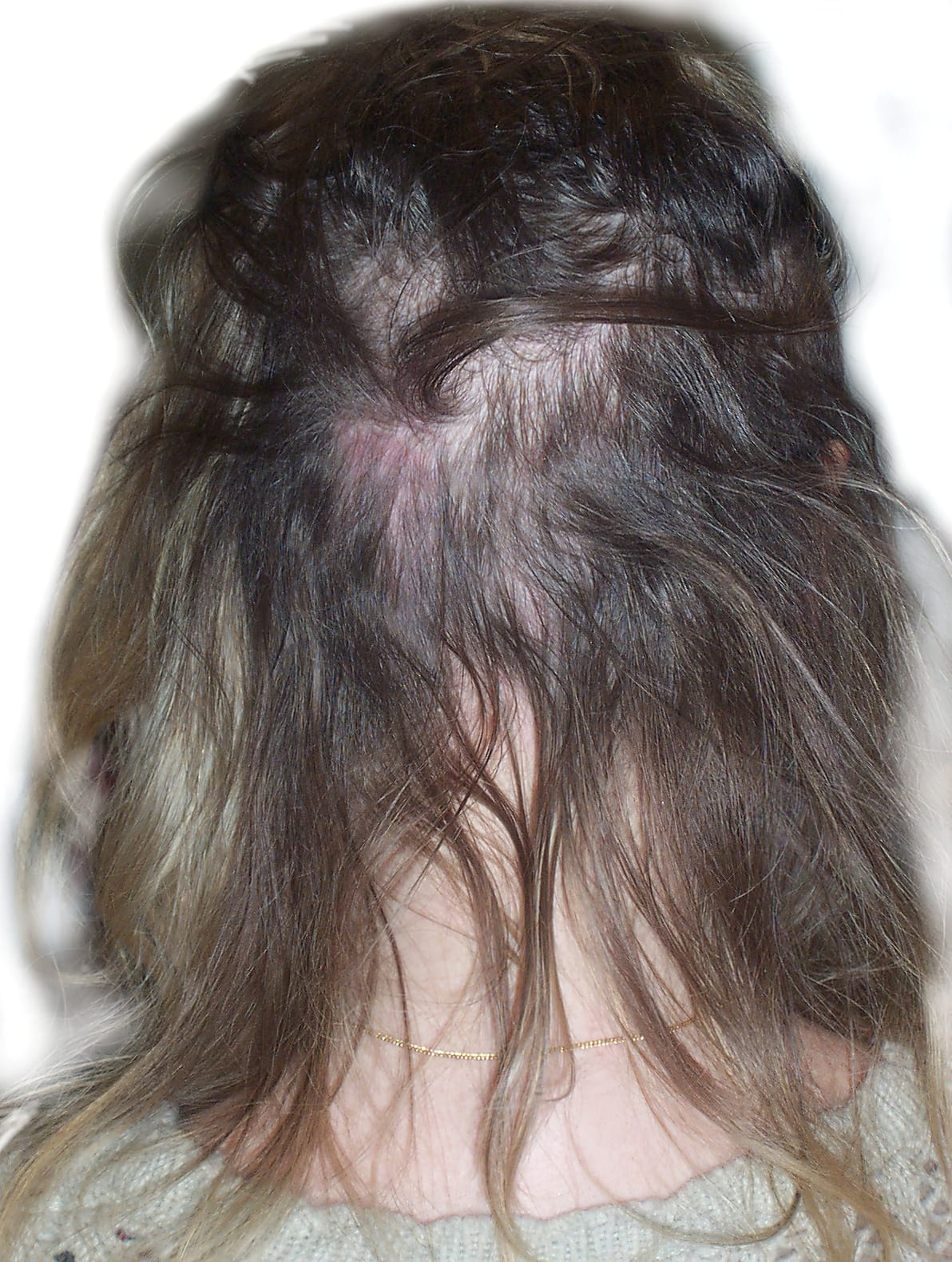 Before Picture - Real Hair Extensions Bald Patches Recovery